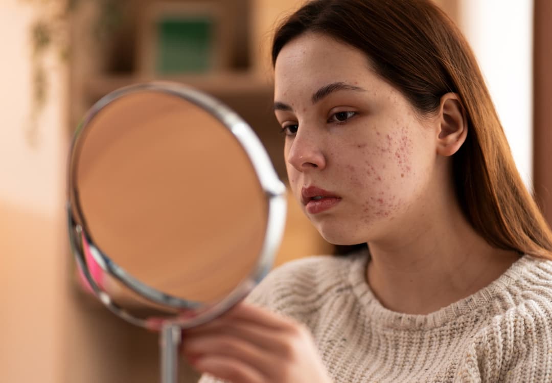 Achieve Clear Skin Naturally: Must-Have Vitamins and Minerals for Acne